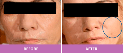 WRINKLE REDUCTION