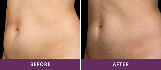 ABDOMINAL FAT REDUCTION