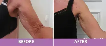 Skin Tightening