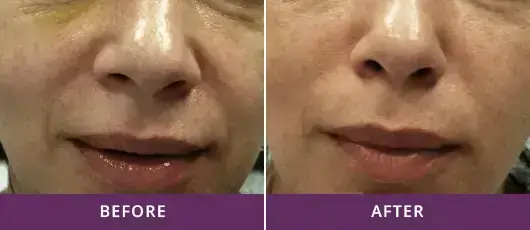 Skin Resurfacing