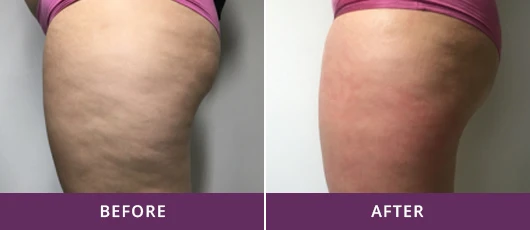 CELLULITE REDUCTION