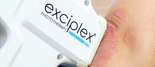 Exciplex 308