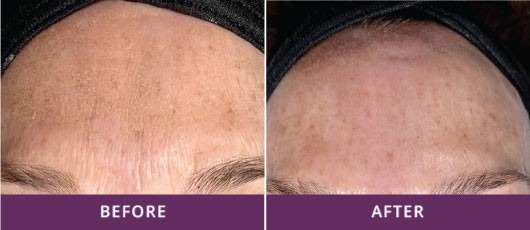 SMOOTHEN FINE LINES AND WRINKLES