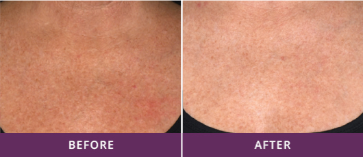 VASCULAR & PIGMENTED LESIONS