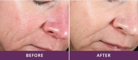 SKIN REJUVENATION