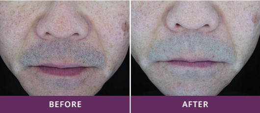 SMOOTH SKIN: REFINING TEXTURE AND TONE