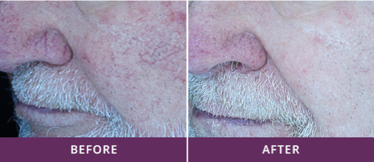 TELANGIECTASIA