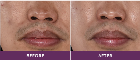 BENIGN PIGMENTED LESIONS
