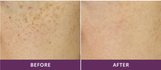 BLEMISHES & MELASMA TREATMENT