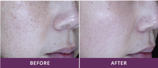 SKIN TONING & REJUVENATION