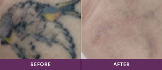 TATTOO REMOVAL