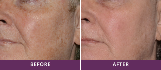 MELASMA TREATMENT
