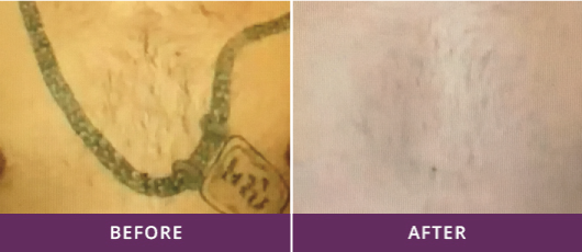 MULTI-COLOR TATTOO REMOVAL