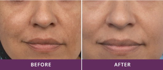 SKIN REVITALIZATION