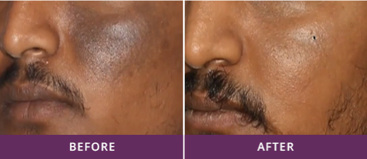 MELASMA TREATMENT