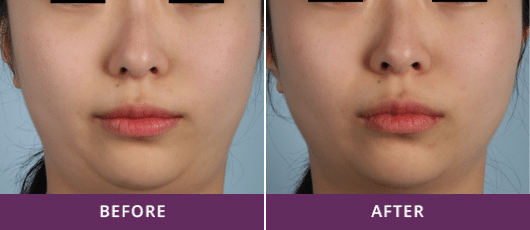 SKIN TIGHTENING