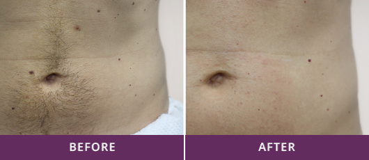 ABDOMINAL HAIR REMOVAL