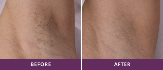 UNDERARM HAIR REMOVAL